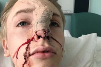 Aiden Noel fue sometido a