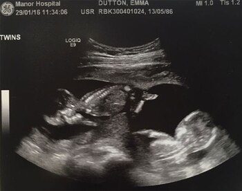 La ecografía que muestra ambos