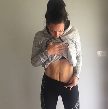 Simone Harbinson fue operada por