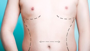 La reducción de mamas es