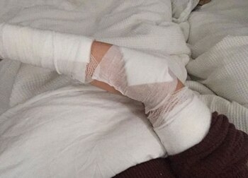 Ambos brazos le quedaron severamente dañados