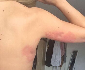 También terminó con quemaduras en