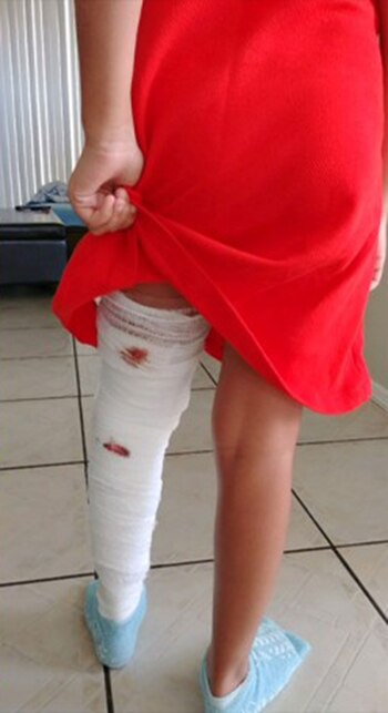 Juliana Ossa muestra las heridas