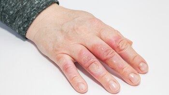 Pronto las quemaduras podrán pasar