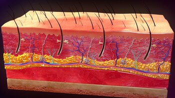 Una quemadura de primer grado