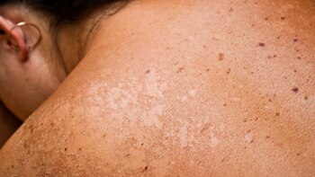 Incluso las quemaduras producto por