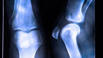 Este traumatismo surge generalmente al