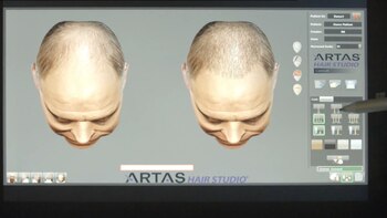 Antes del procedimiento se realiza