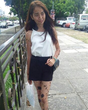La joven nación con una extraña anomalía que lleva el nombre de Nevus Melanocítico Congénito que ocurre en aproximadamente el 1% de la población mundial