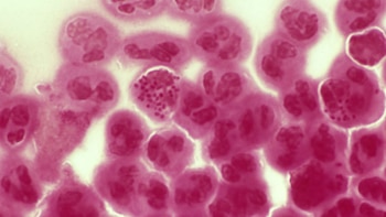 Imagen el microscopio de la enfermedad