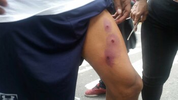 Varios manifestantes resultaron heridos de perdigones (@ChristianJohan)