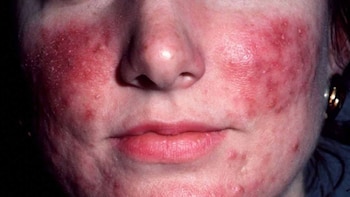 Estímulos aplicados en forma reiterada