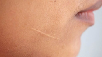 Las cicatrices se producen por