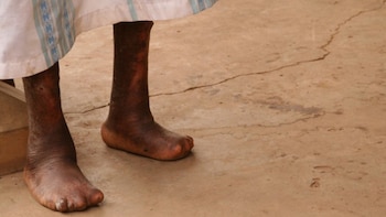 De no tratarse a tiempo,