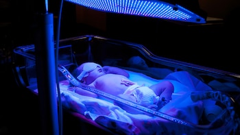 En niveles altos de ictericia