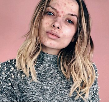 Muestra su acné para animar a