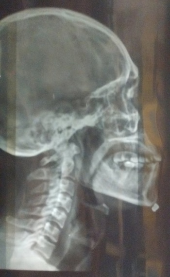 En el mentón, uno de