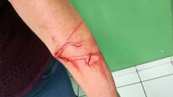 Así quedó el brazo de