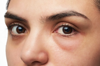 El tratamiento Thermage es también llamado el ‘lifting sin cirugía’. Se busca borrar los signos de cansancio, reducir la flacidez y recuperar el contorno facial (Getty Images)