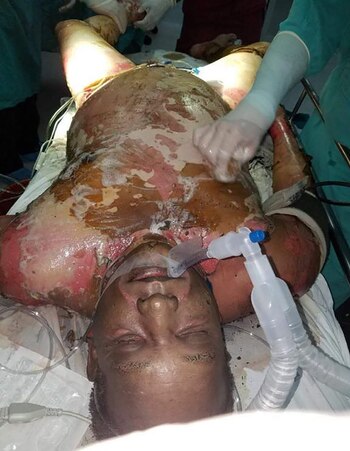 Se ha reportado al menos