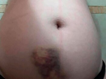 Las lesiones que sufrió la