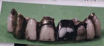 Frangmentos de la prótesis con