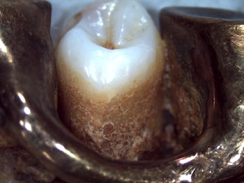 Detalle de un diente y