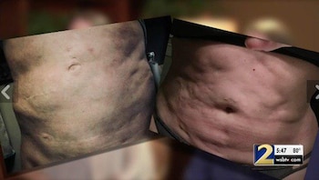 Dos muestras de las lesiones