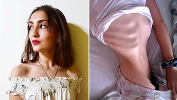 Camila, una joven de 16 años que decidió mostrar el impacto de la anorexia en su cuerpo y su felicidad actual por estar en recuperación. La foto se volvió viral en las redes.