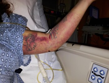 Así tenía el brazo Ángela