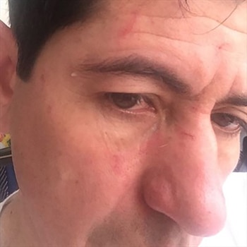 El mandatario muestra las lesiones