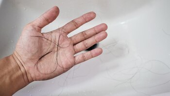La pérdida de cabello es