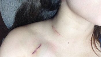 Las dos cicatrices de Paola