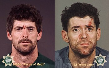 Los efectos del abuso de metanfetaminas en sólo dos años y medio