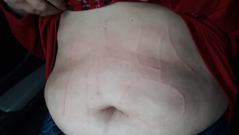 Las marcas en el abdomen