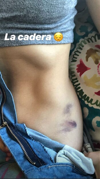 El moretón que le quedó