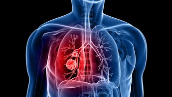 El cáncer de pulmón es