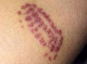 La picadura de que sufrió