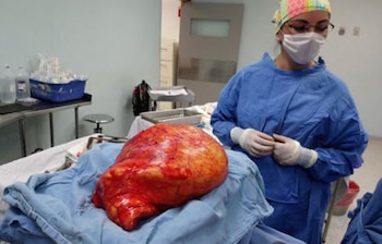 El tumor, de 17 kilogramos,