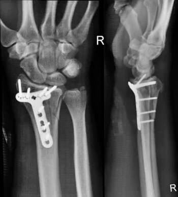 “Me instalaron una placa de