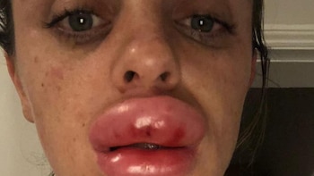 Así le quedaron los labios