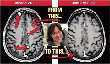 Sus tumores cerebrales desaparecieron (Foto: