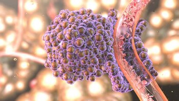 Los tumores de cáncer de