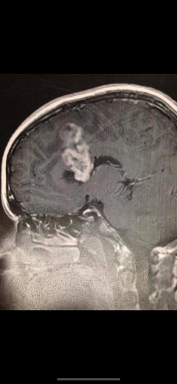 Una resonancia reveló el tumor de Drew. (Foto: Facebook, Drew Gunby)