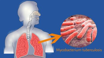 Es una enfermedad infectocontagiosa crónica