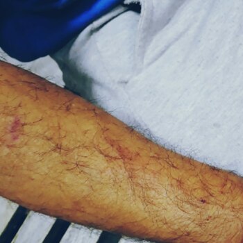 El brazo de Rojas presentaba