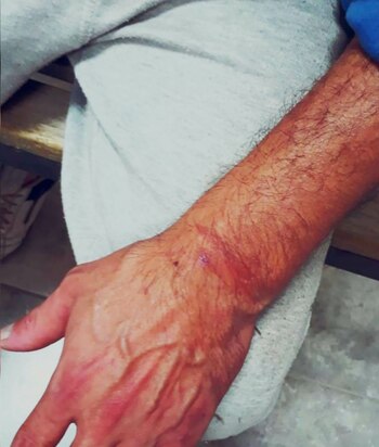 Los brazos del imputado presentaron