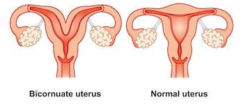 Un útero didelfo es una