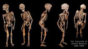 El esqueleto de Joseph Merrick