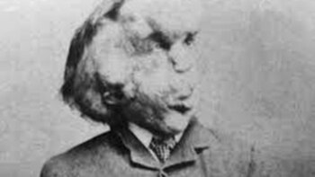Joseph Merrick.